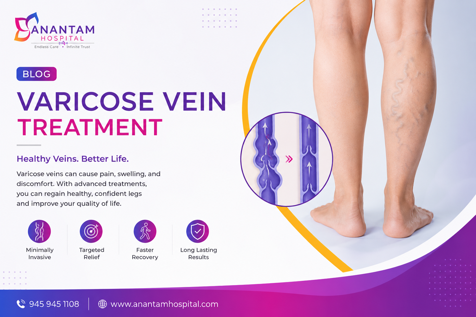 Varicose Vein Treatment at Anantam Hospital